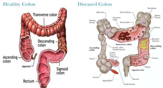 Is Colon Hydrotherapy Worth A Try?